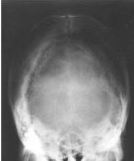 Skull Axial Positioning